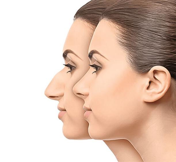 How to Get a Free Nose Job in Canada